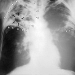 Tuberculose poumon