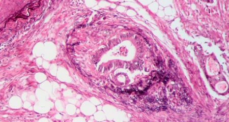 Cancer colorectal
